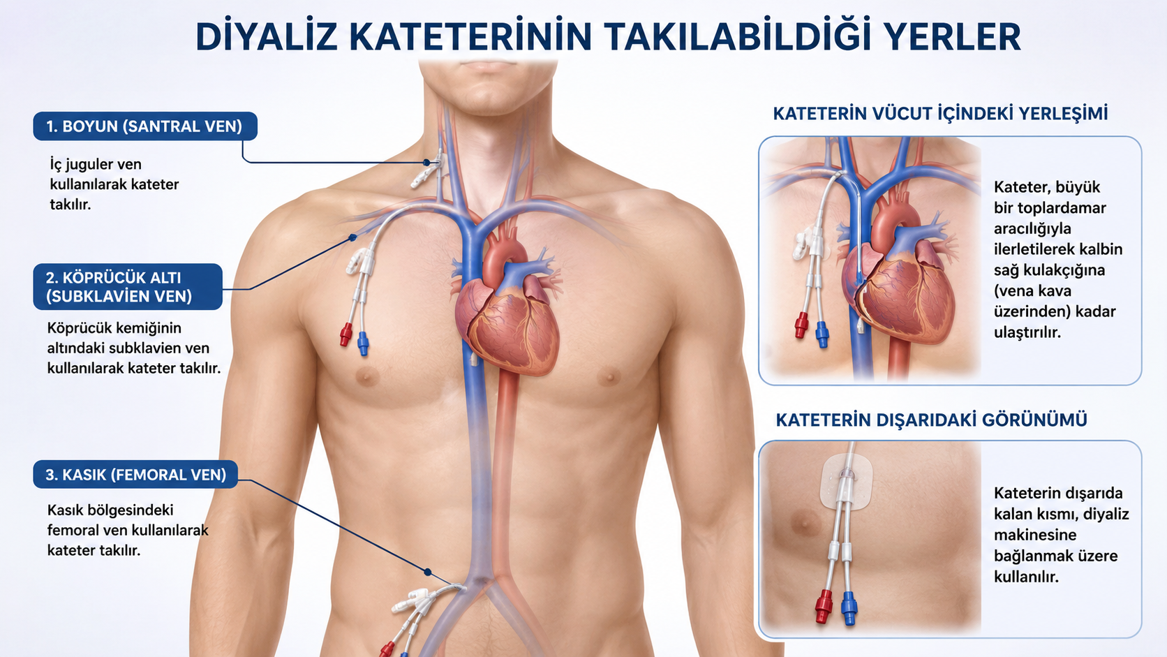 Diyaliz kateteri takılabilen bölgeler